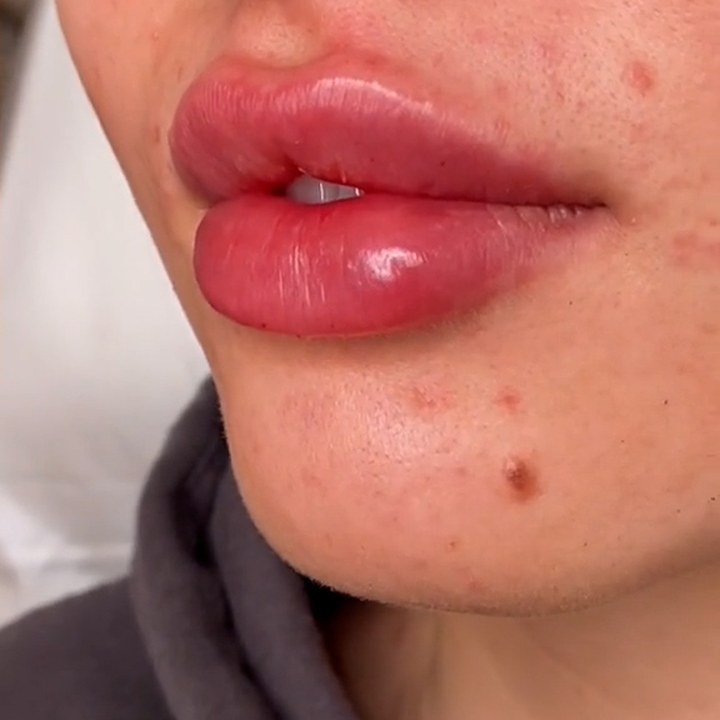 Depois - Caso 83 Preenchimento Labial