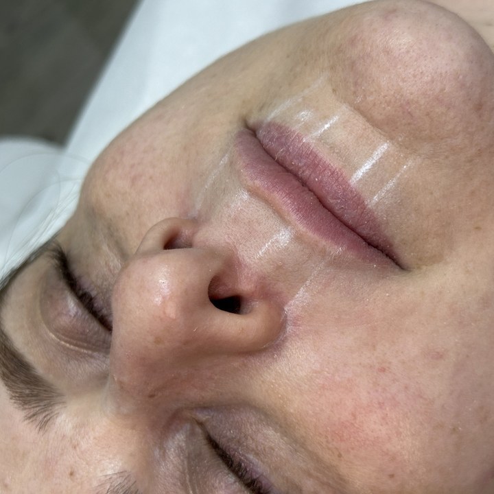 Antes - Caso 88 Preenchimento Labial