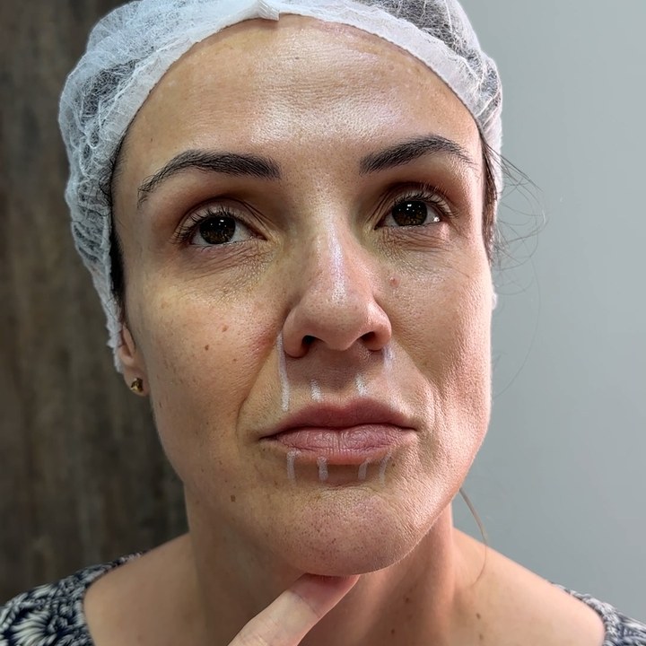 Antes - Preenchimento Labial - Est&eacute;tica Batel Curitiba