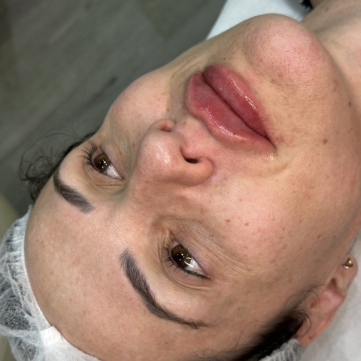 Depois - Preenchimento Labial - Est&eacute;tica Batel Curitiba