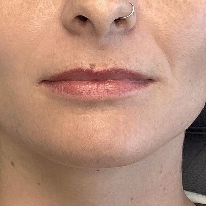 Antes - Caso 09 Preenchimento Labial
