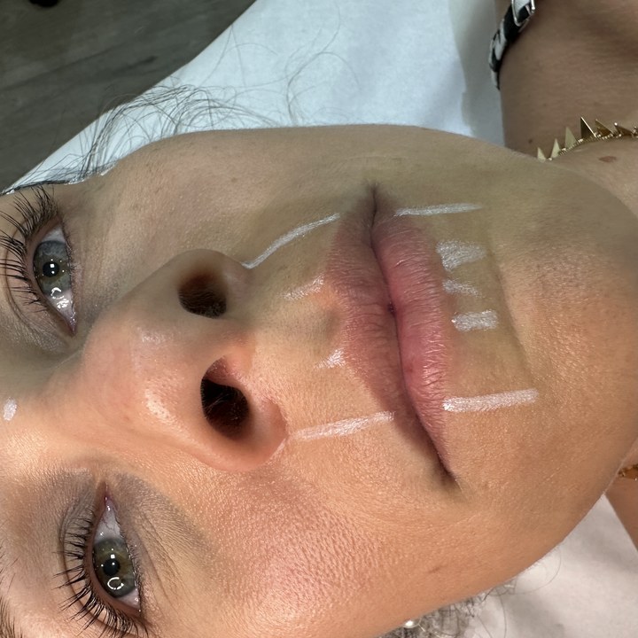 Antes - Caso 93 Preenchimento Labial