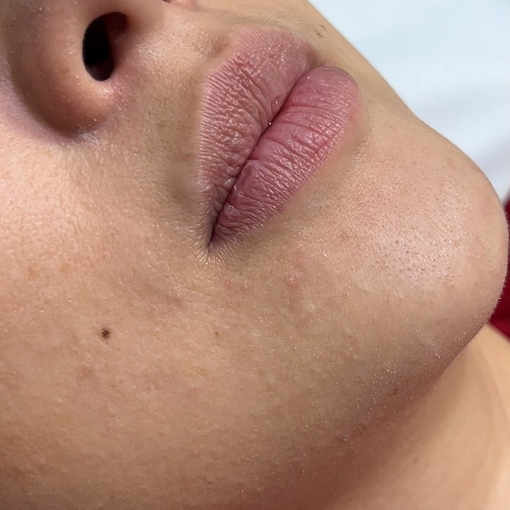 Antes - Caso 94 Preenchimento Labial