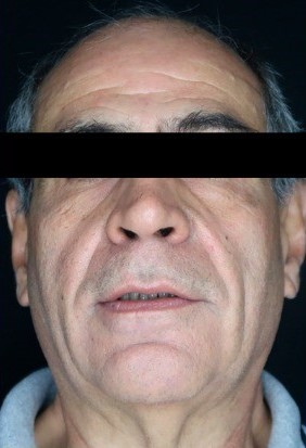 Antes - Rejuvenescimento - Est&eacute;tica Batel Curitiba