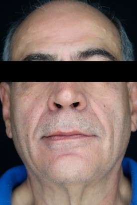 Caso 71 - Rejuvenescimento do terço inferior