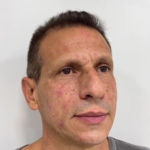 Resultado de rejuvenescimento facial masculino