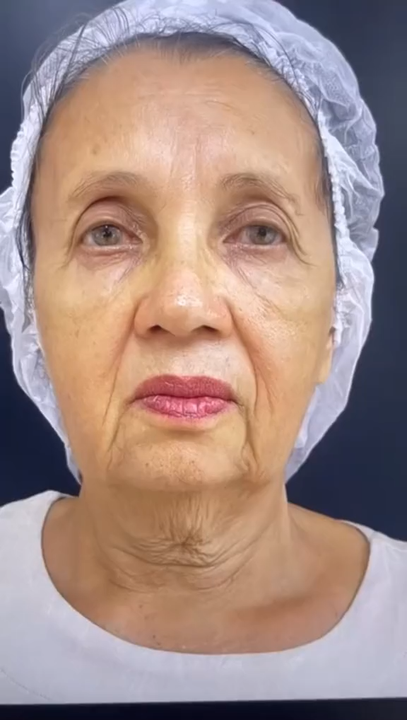 Antes - Rejuvenescimento - Est&eacute;tica Batel Curitiba