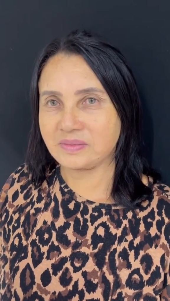 Depois - Rejuvenescimento - Est&eacute;tica Batel Curitiba