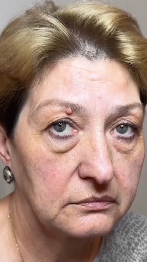 Antes - Rejuvenescimento - Est&eacute;tica Batel Curitiba