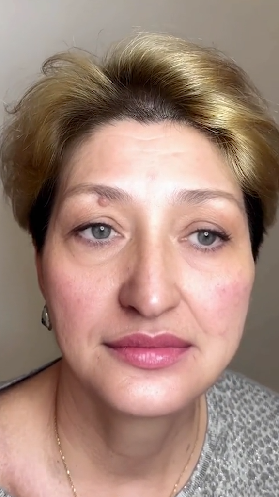 Depois - Rejuvenescimento - Est&eacute;tica Batel Curitiba