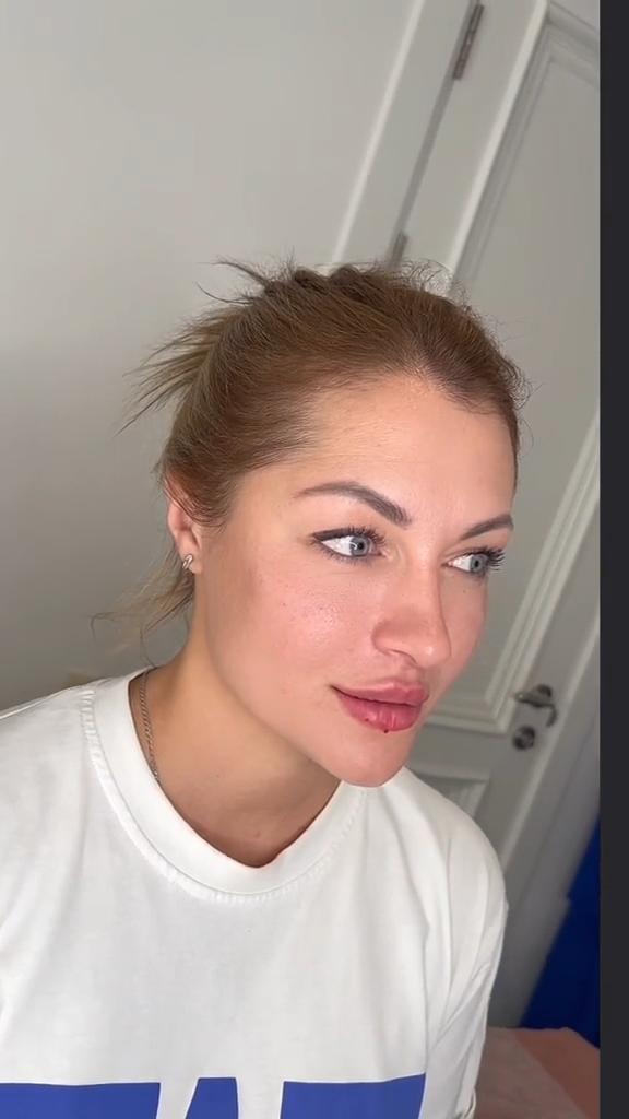 Rejuvenescimento caso 035 — antes e depois