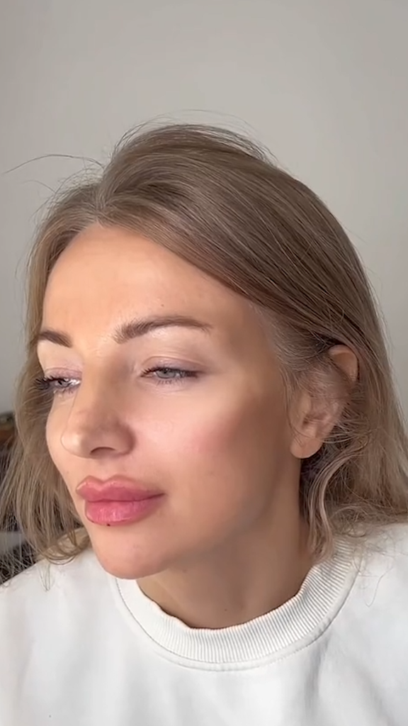 Rejuvenescimento caso 036 — antes e depois