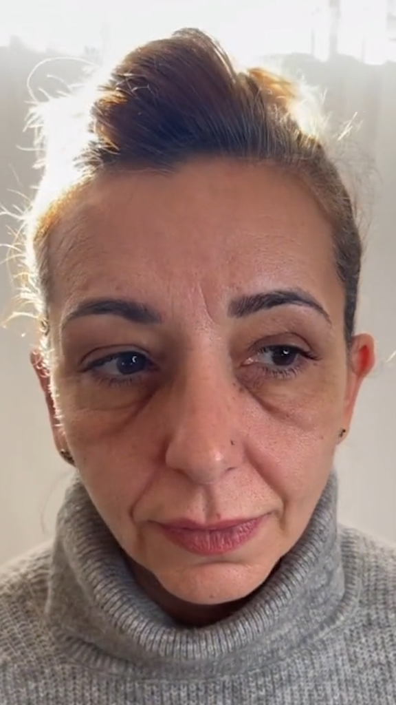 Antes - Rejuvenescimento - Est&eacute;tica Batel Curitiba