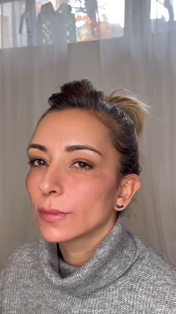 Depois - Rejuvenescimento - Est&eacute;tica Batel Curitiba