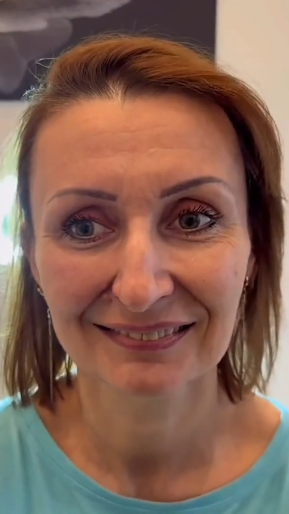 Antes - Rejuvenescimento caso 55