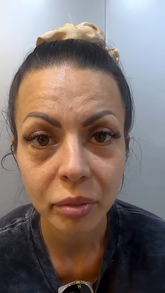 Antes - Rejuvenescimento - Est&eacute;tica Batel Curitiba