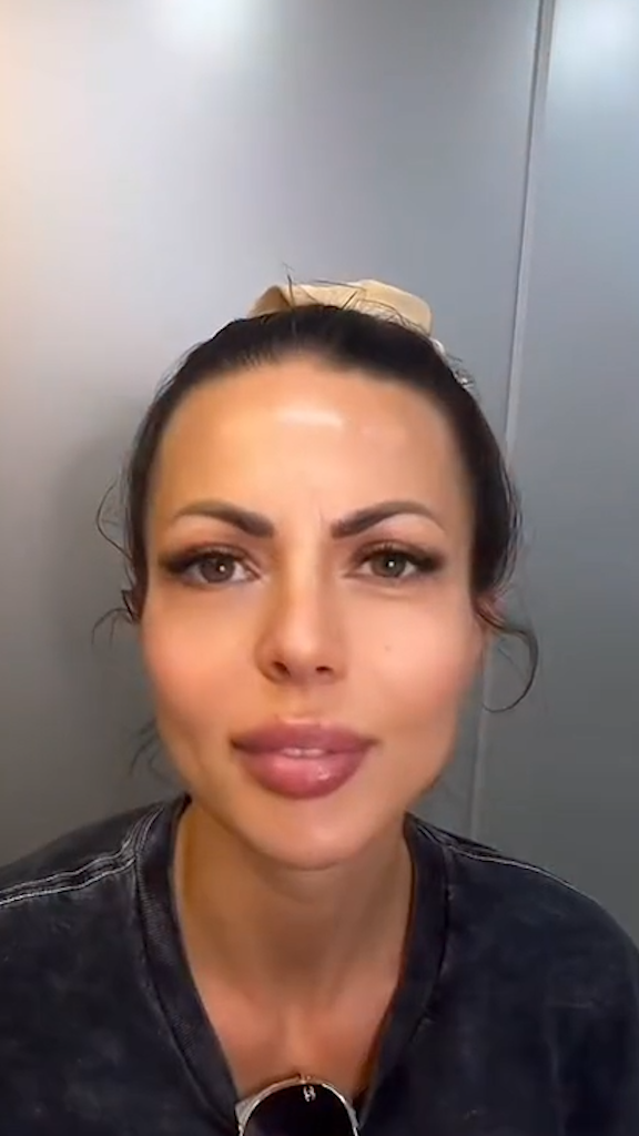 Depois - Rejuvenescimento - Est&eacute;tica Batel Curitiba