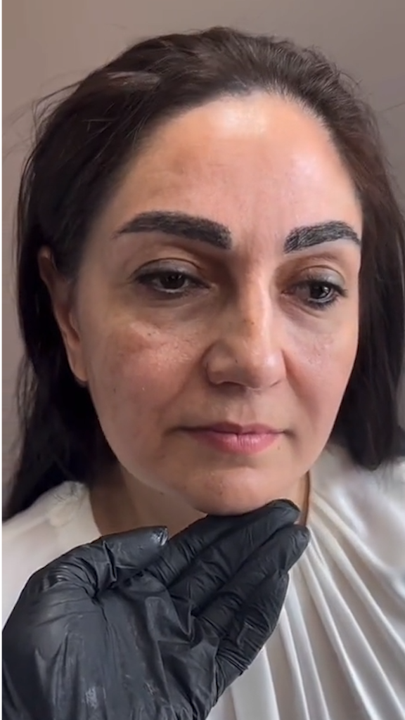 Antes - Rejuvenescimento caso 68