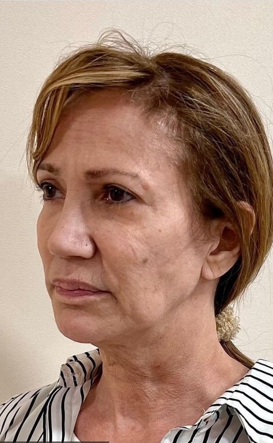 Antes - Rejuvenescimento caso 70