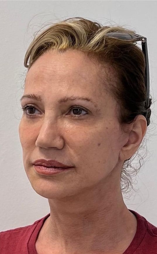 Depois - Rejuvenescimento caso 70