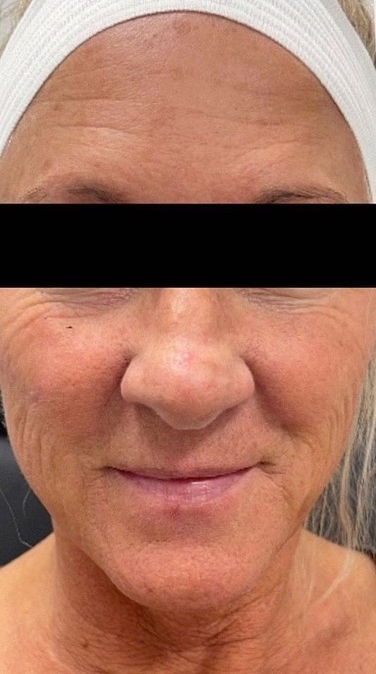 Antes - Rejuvenescimento caso 74
