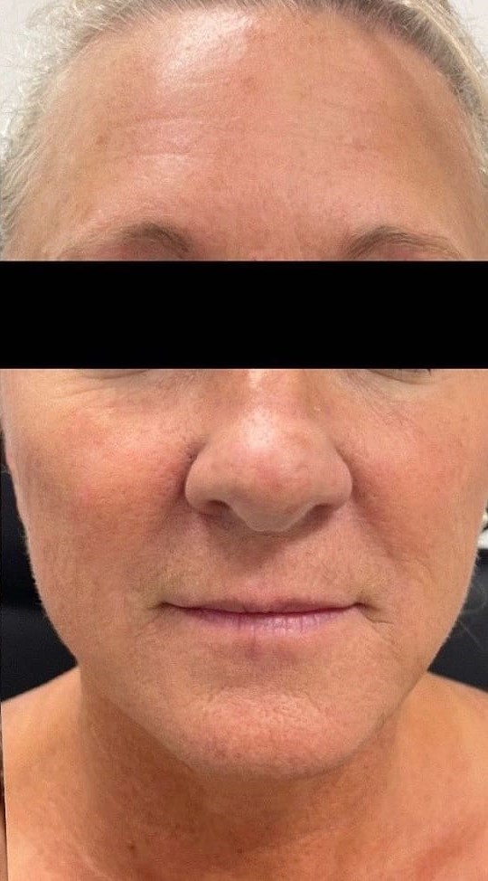 Depois - Rejuvenescimento caso 74