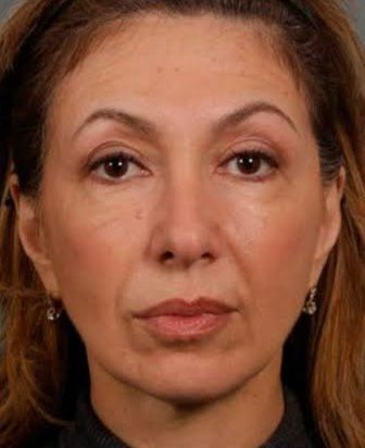 Depois - Rejuvenescimento - Est&eacute;tica Batel Curitiba