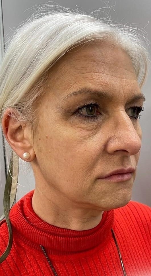 Antes - Rejuvenescimento - Est&eacute;tica Batel Curitiba