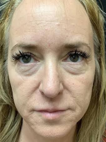 Antes - Rejuvenescimento - Est&eacute;tica Batel Curitiba