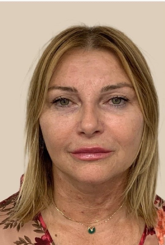 Depois - Rejuvenescimento - Est&eacute;tica Batel Curitiba