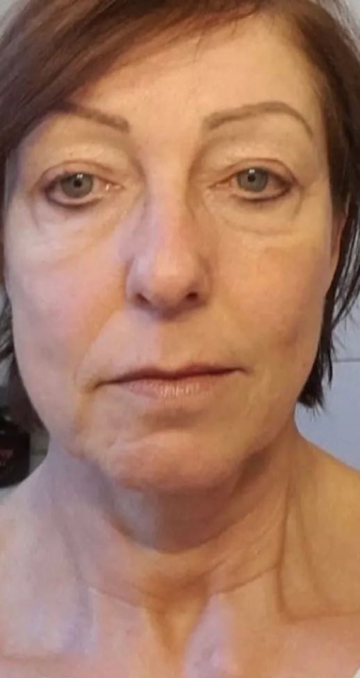 Caso 89 - Rejuvenescimento com suavização das rugas dos olhos