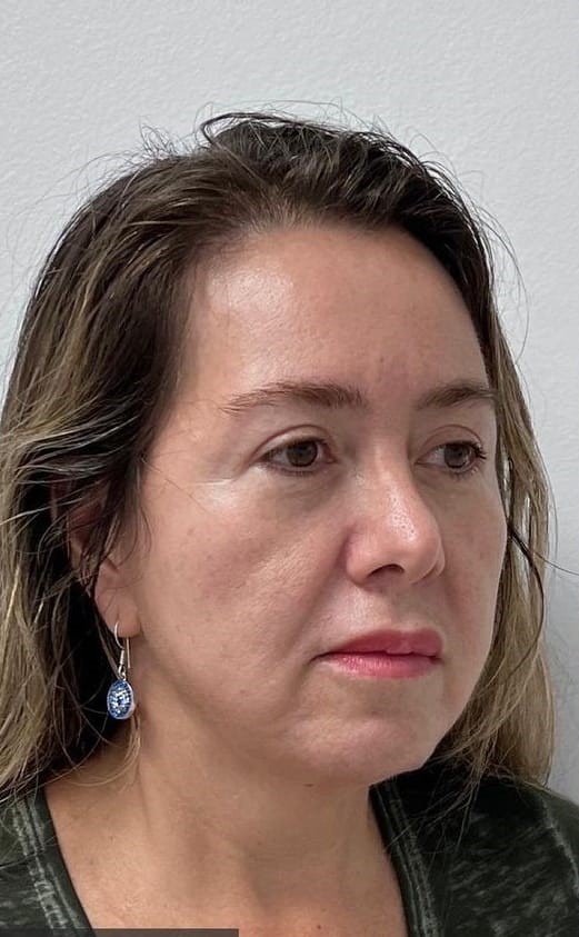 Antes - Rejuvenescimento - Est&eacute;tica Batel Curitiba