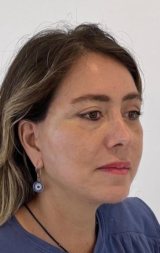 Depois - Rejuvenescimento - Est&eacute;tica Batel Curitiba