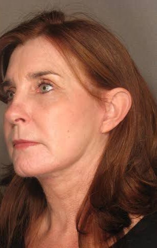 Rejuvenescimento caso 097 — antes e depois