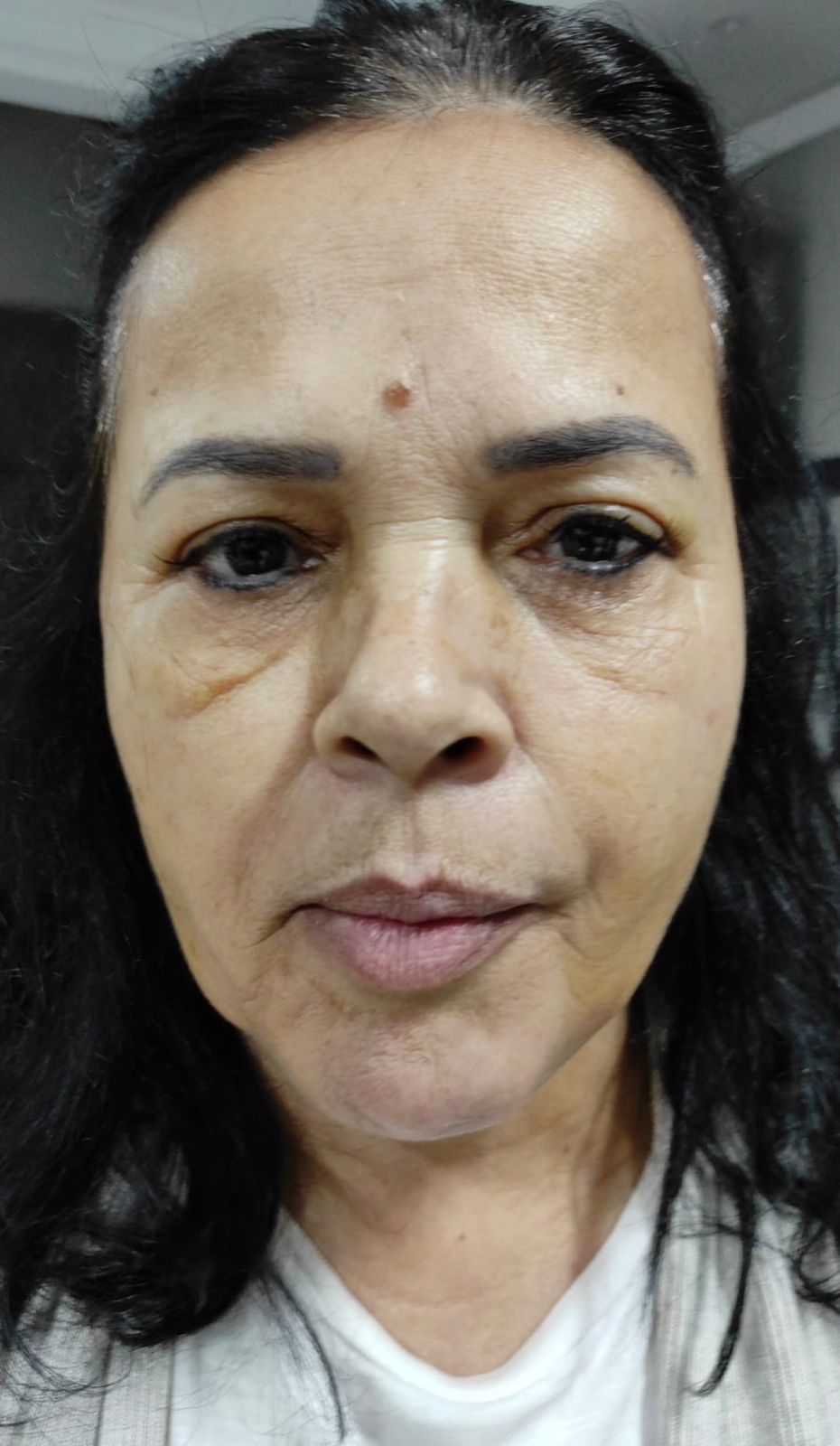 Antes - Rejuvenescimento - Est&eacute;tica Batel Curitiba