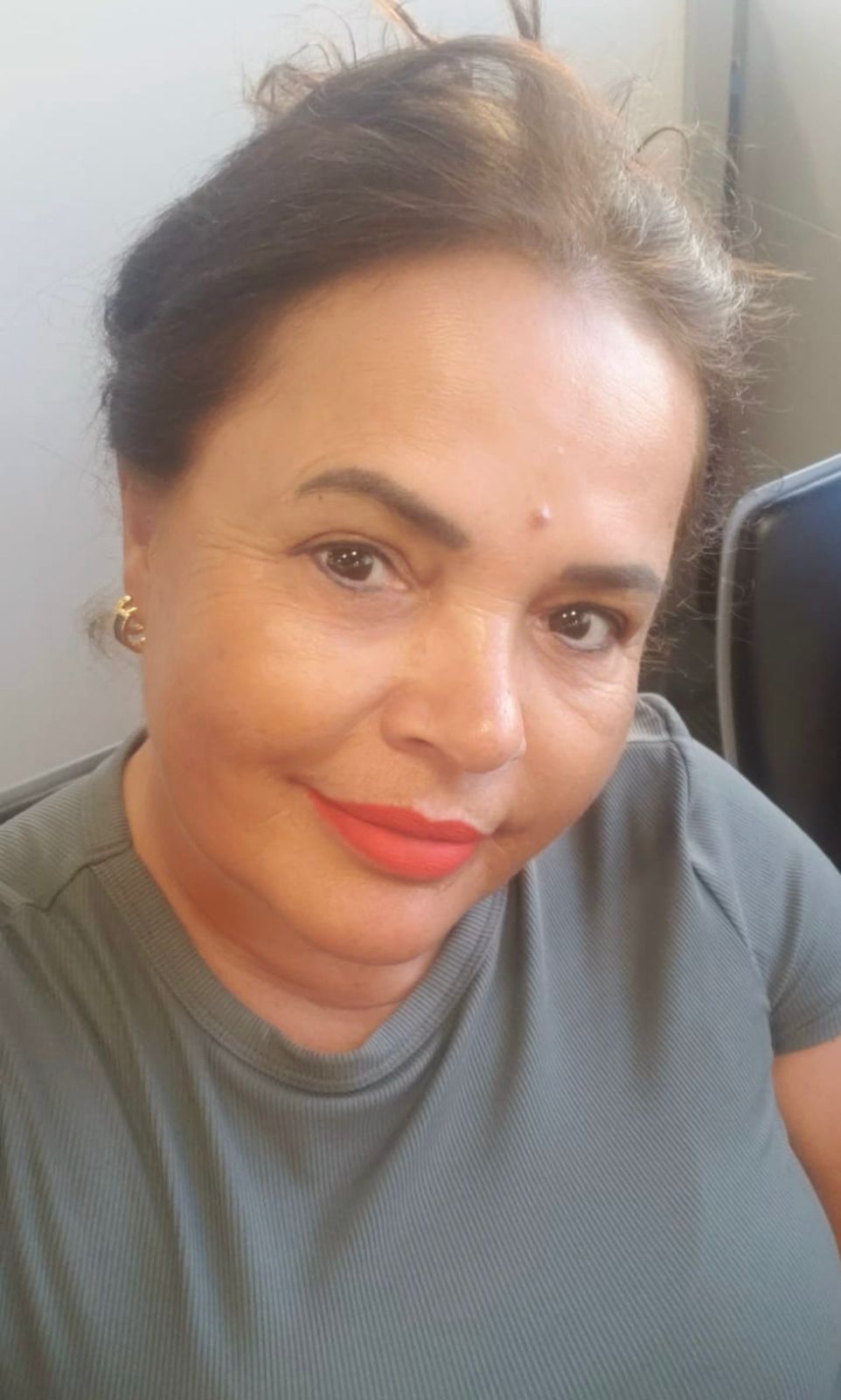 Depois - Rejuvenescimento - Est&eacute;tica Batel Curitiba