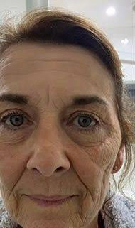 Antes - Rejuvenescimento - Est&eacute;tica Batel Curitiba