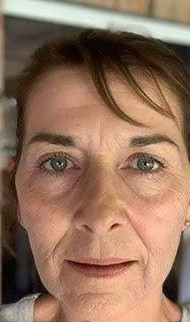 Depois - Rejuvenescimento - Est&eacute;tica Batel Curitiba