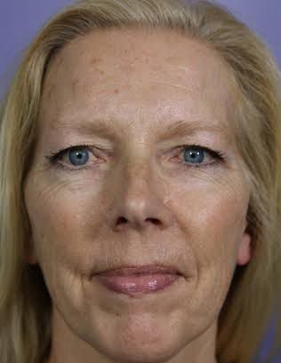 Antes - Rejuvenescimento - Est&eacute;tica Batel Curitiba