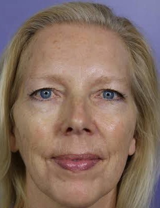 Depois - Rejuvenescimento - Est&eacute;tica Batel Curitiba