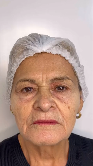 Antes - Rejuvenescimento - Est&eacute;tica Batel Curitiba