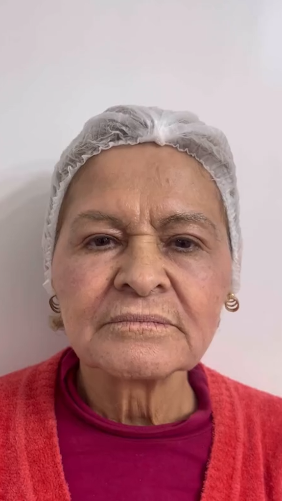 Rejuvenescimento caso 105 — antes e depois