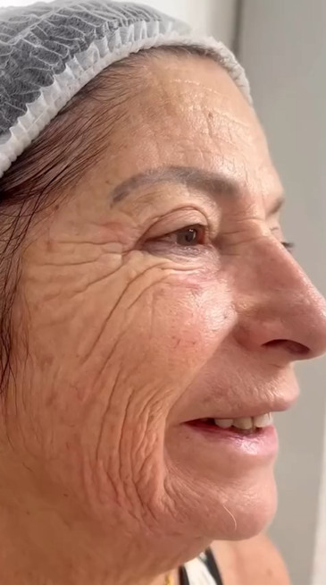 Antes - Rejuvenescimento caso 106