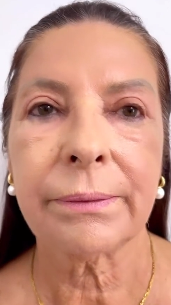 Rejuvenescimento caso 106 — antes e depois