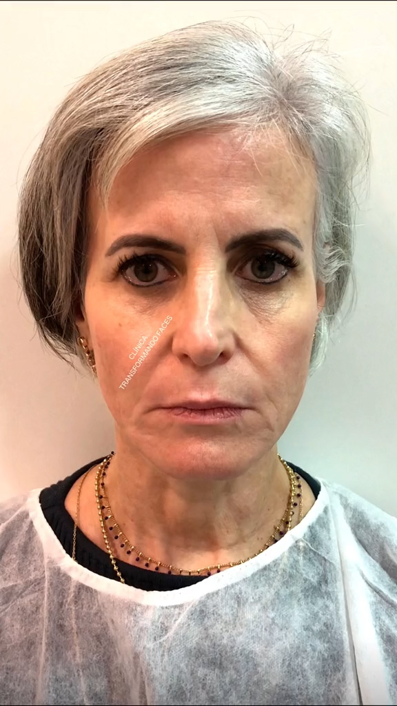 Antes - Rejuvenescimento - Est&eacute;tica Batel Curitiba
