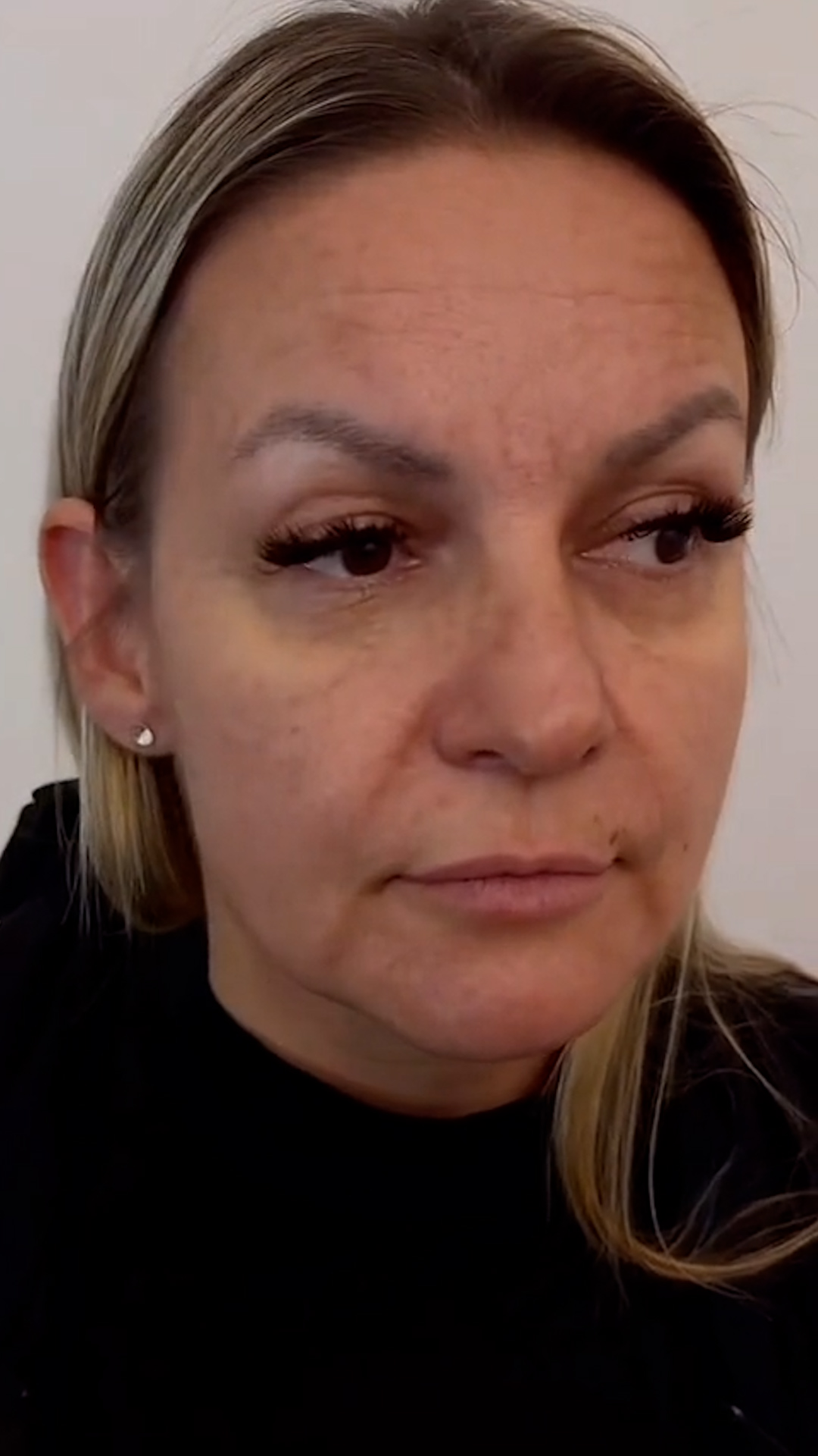Antes - Rejuvenescimento - Est&eacute;tica Batel Curitiba