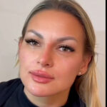 Resultado de rejuvenescimento facial
