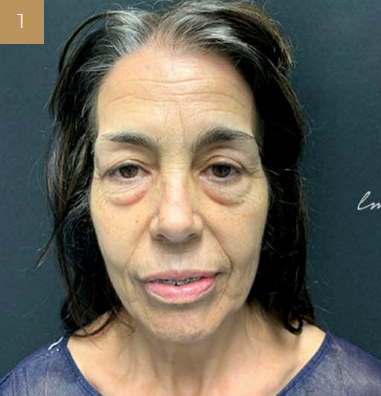 Antes - Rejuvenescimento - Est&eacute;tica Batel Curitiba