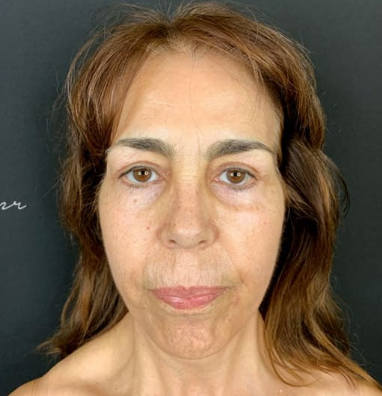 Depois - Rejuvenescimento - Est&eacute;tica Batel Curitiba