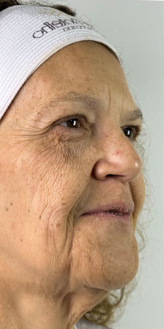 Antes - Rejuvenescimento - Est&eacute;tica Batel Curitiba